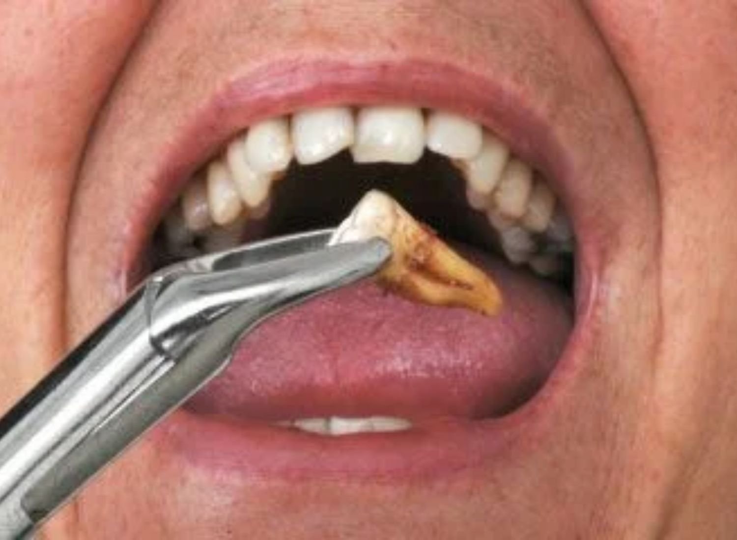 Tooth Extraction
