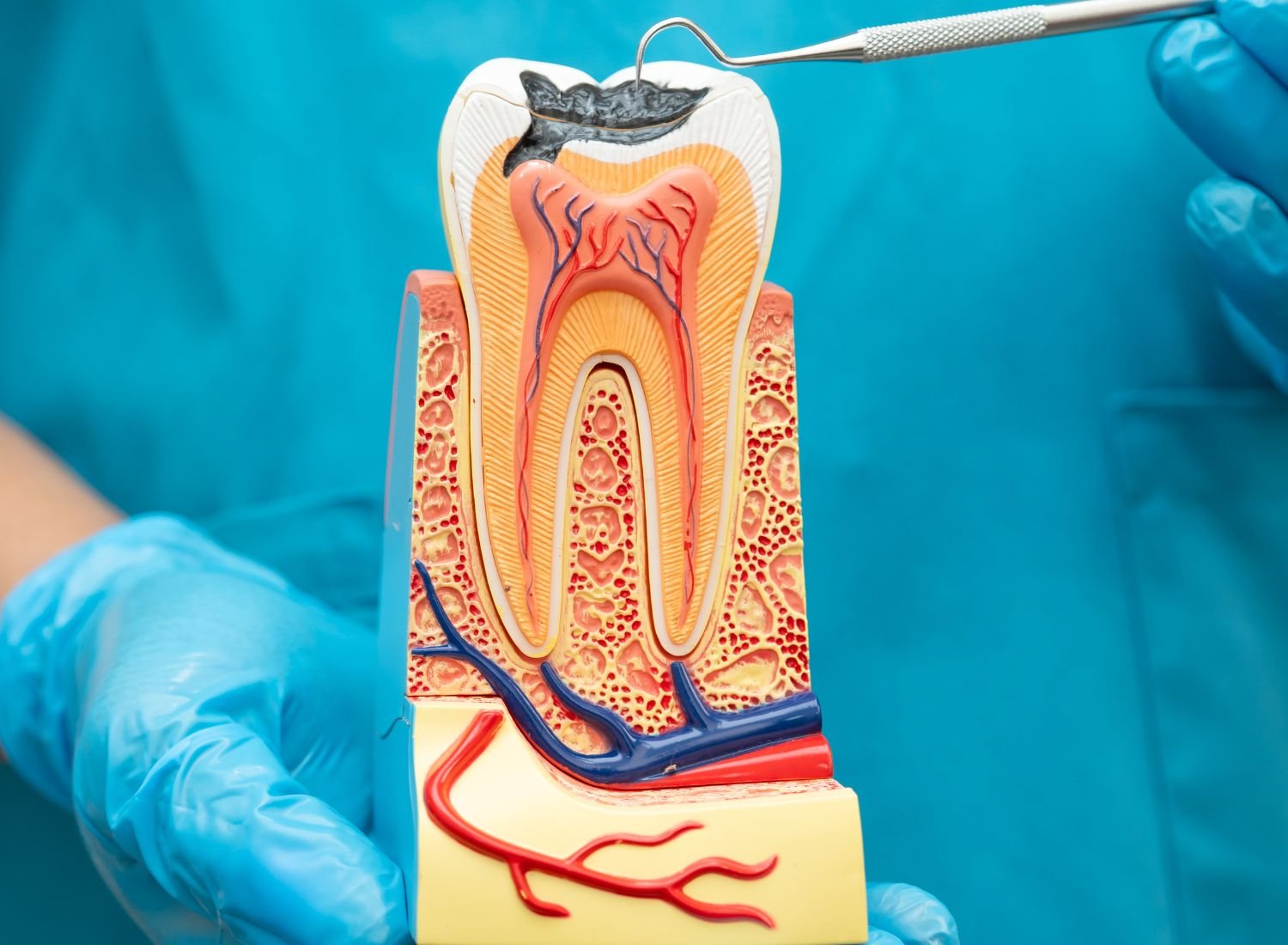 Root Canal Treatment