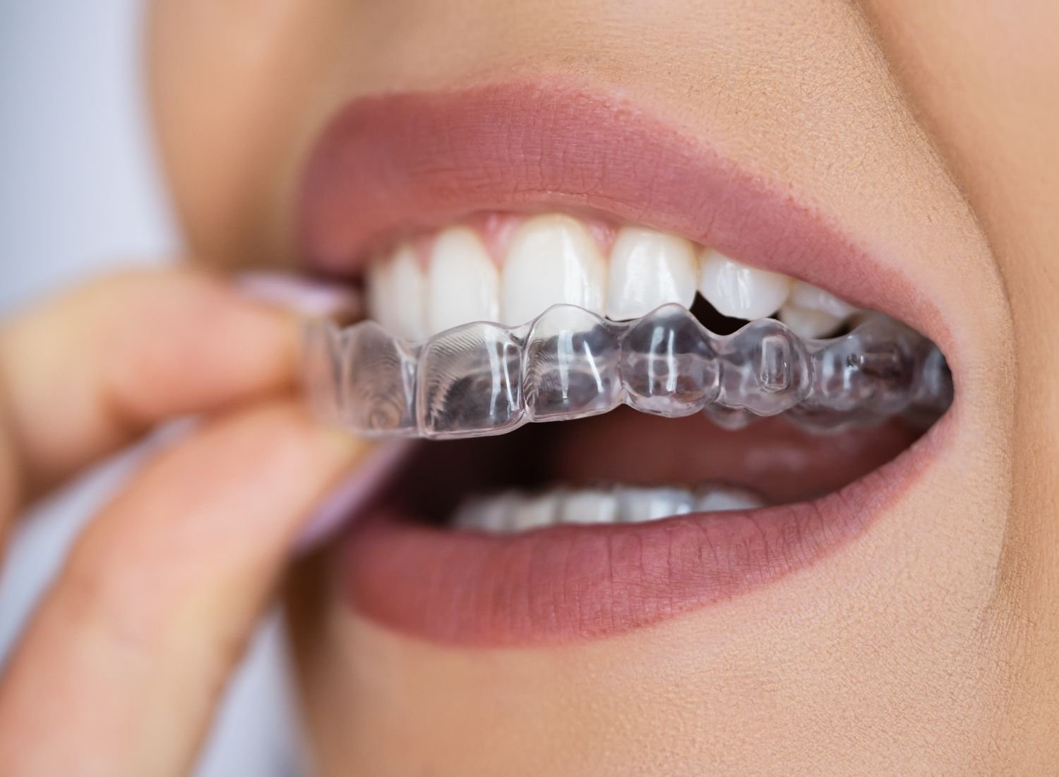 Clear Aligners