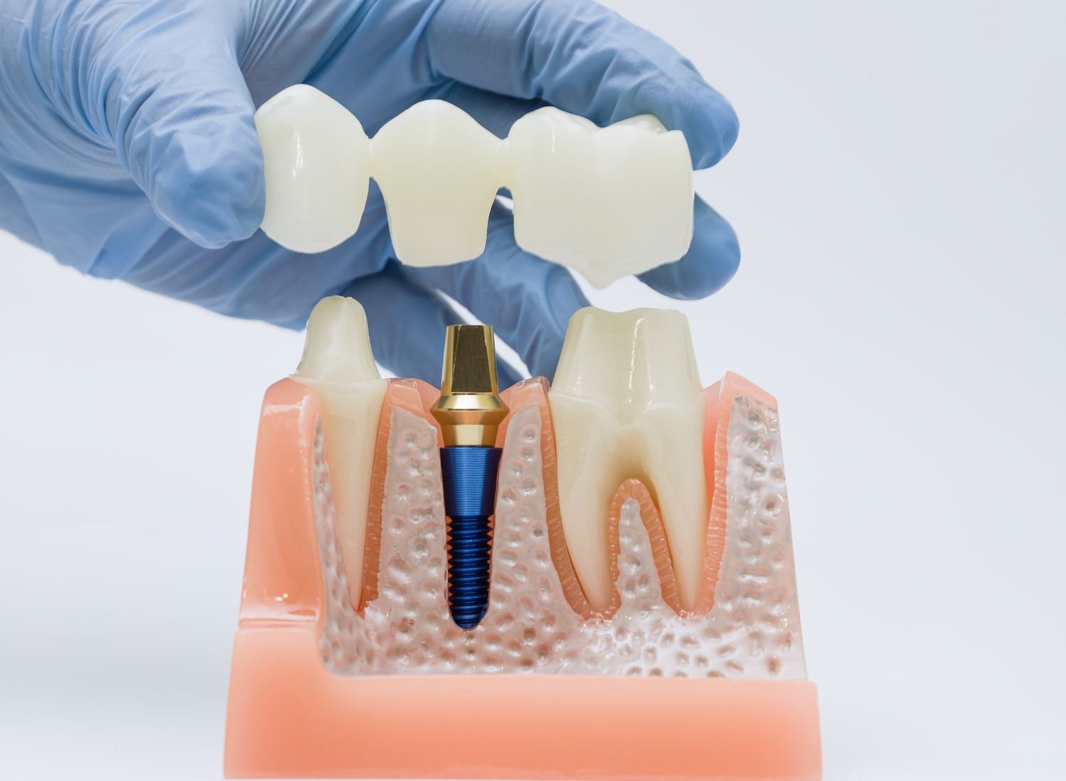 Dental Crowns