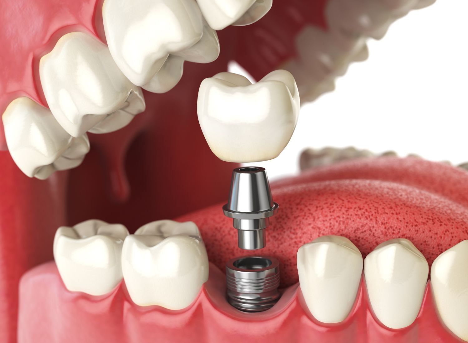 Dental Implants