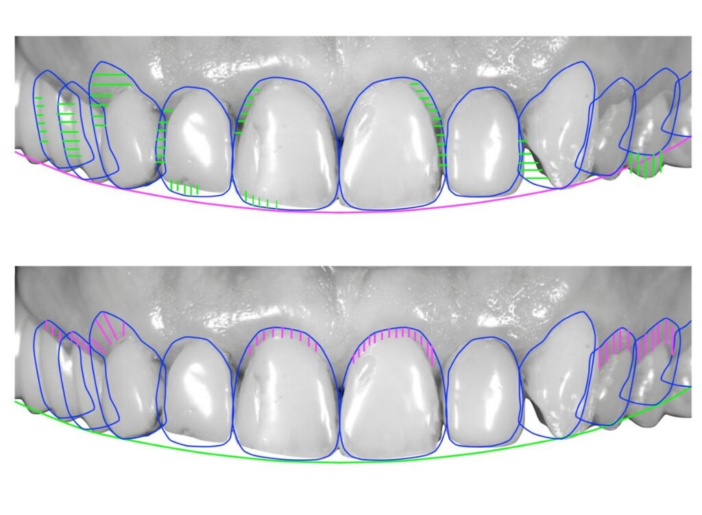 smile designing