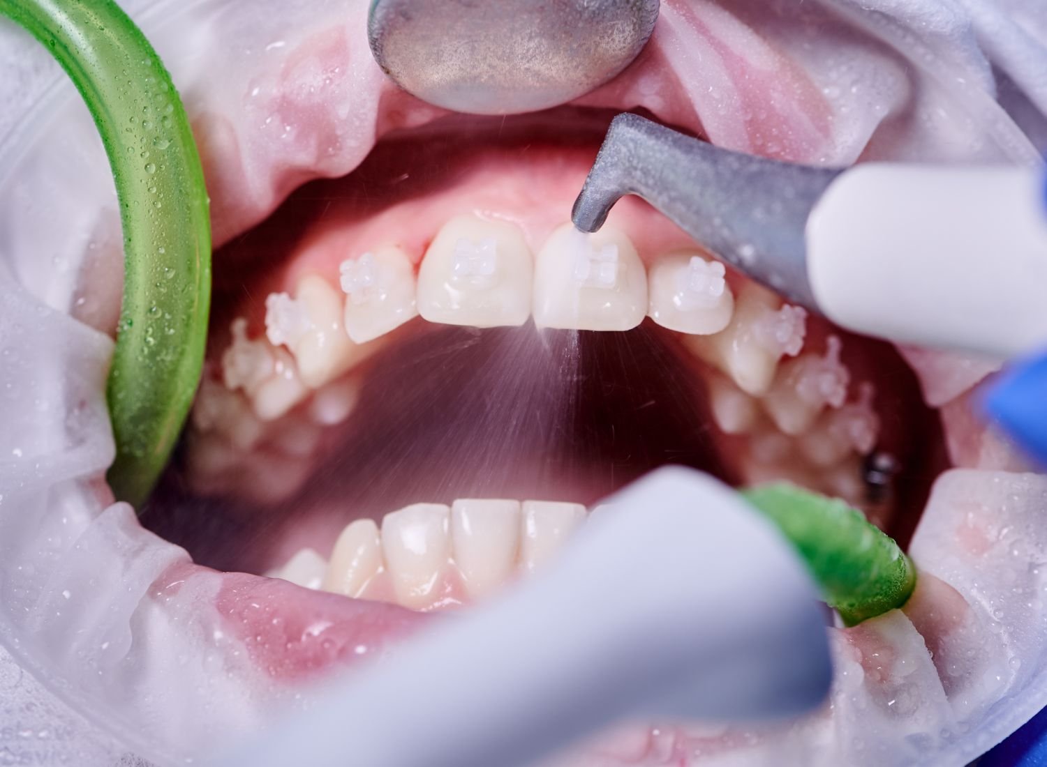 Teeth Cleaning